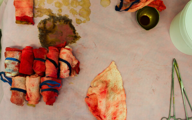 Photo de détails au bloc opératoire lors d'une opération chirurgicale photographiée au Pôle digestif Lyon Est (UCGT)